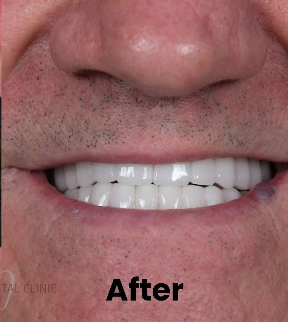 After – Failing Teeth Replacement