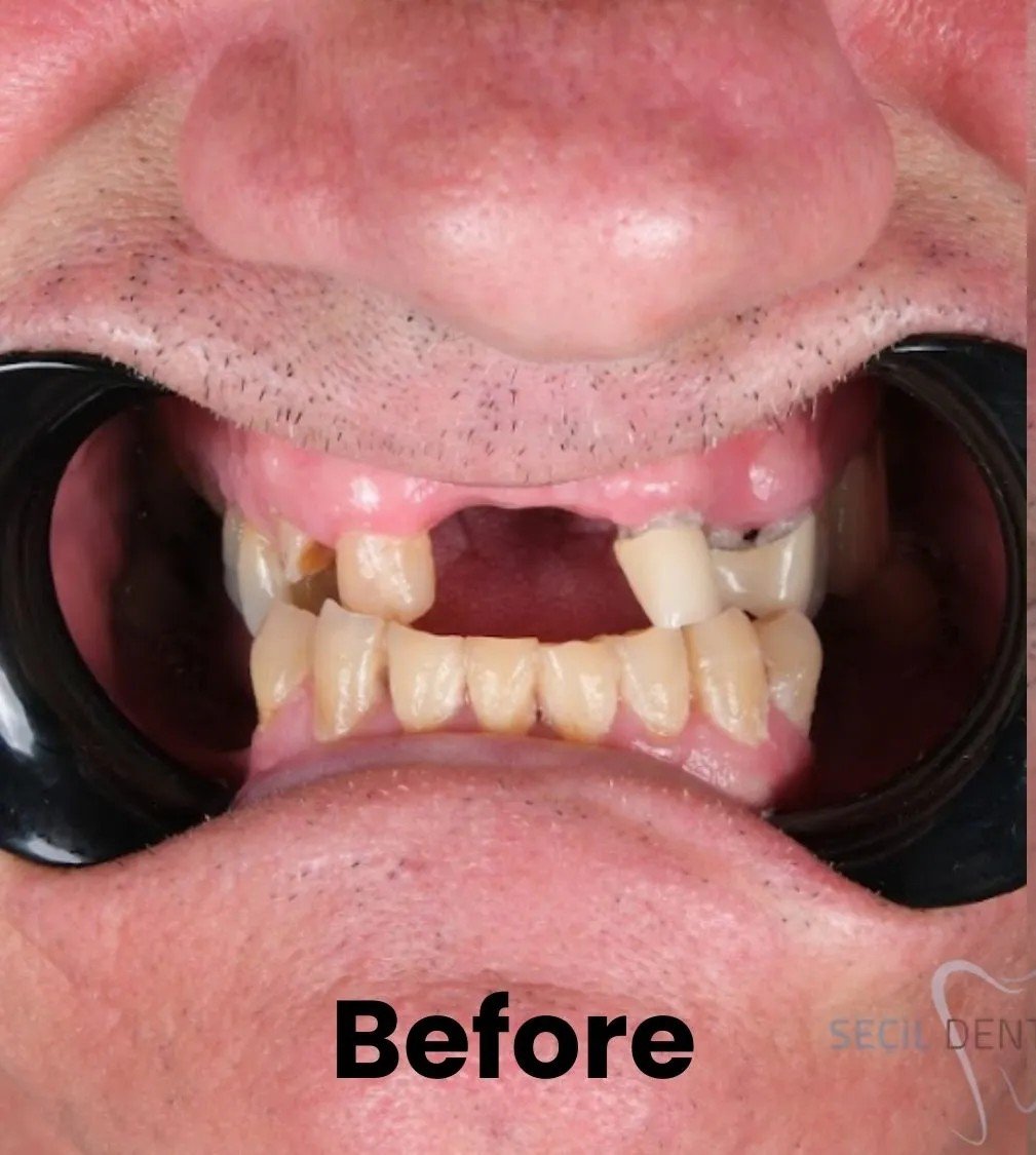 Before – Failing Teeth Replacement